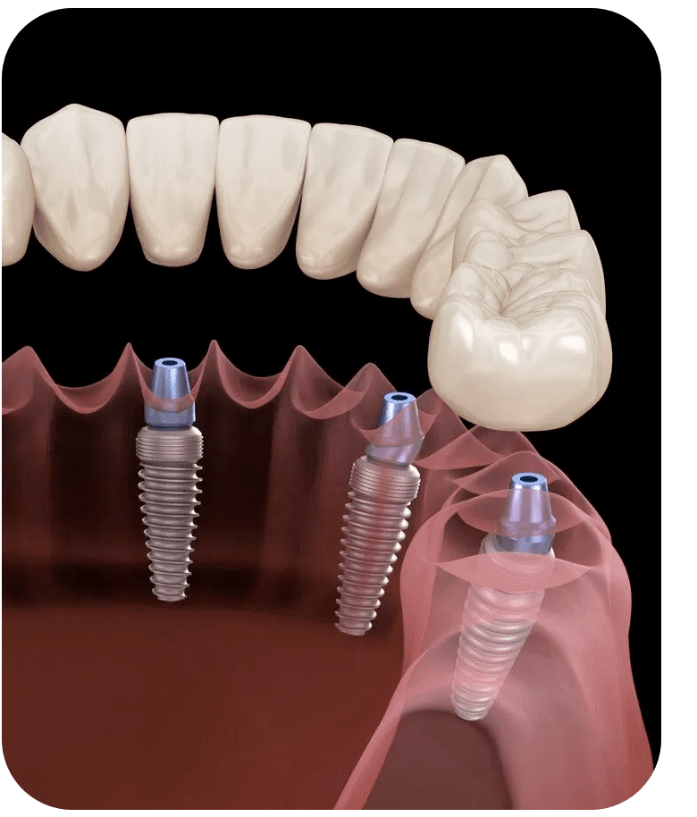 All on 4 Dental Implant Treatment Abroad