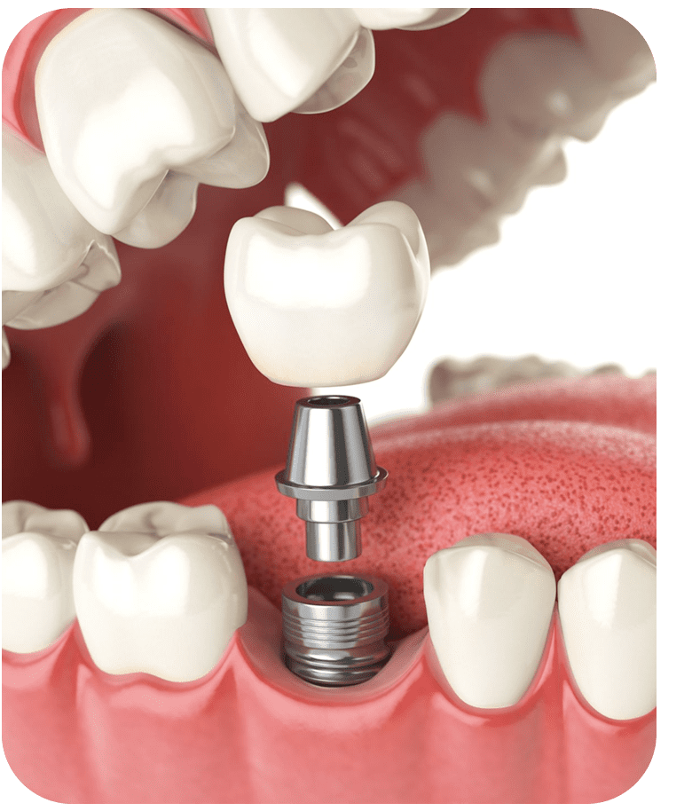 Dental Implant Treatment Abroad