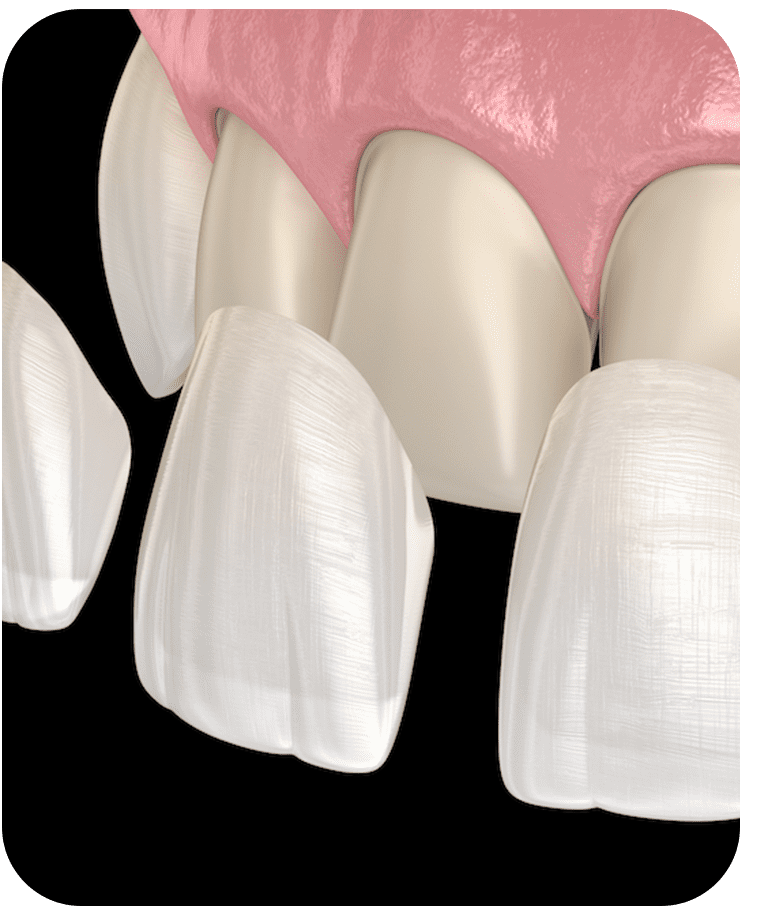 Dental Veneers Treatment Abroad