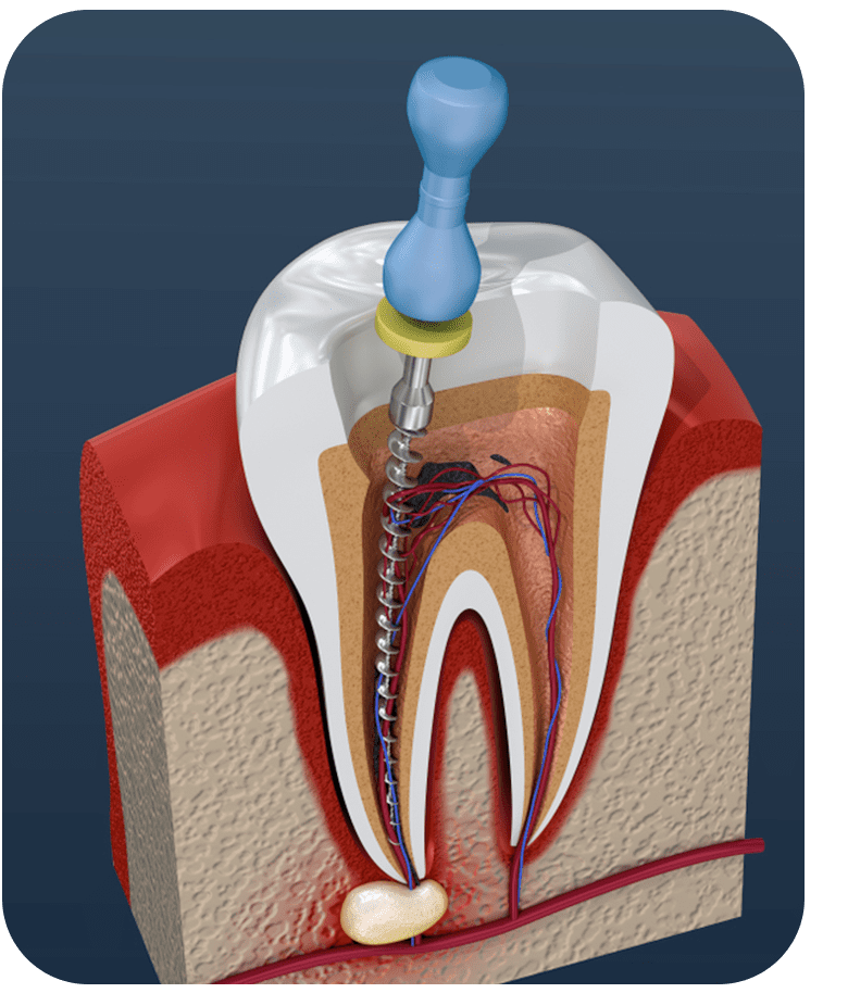 Root Canal Dental Treatment Abroad